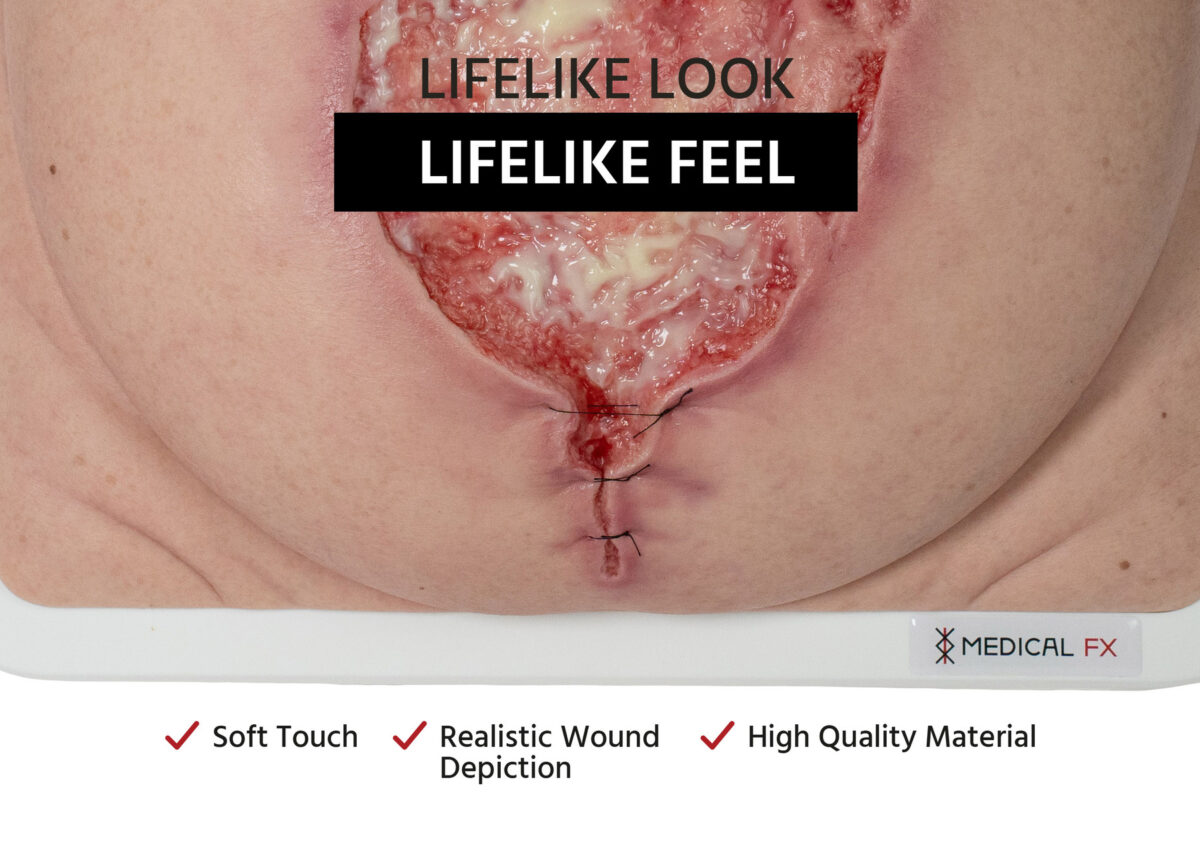 Frame Model 육아 조직이 있는 파열된 복부