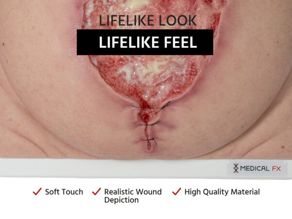 Frame Model 육아 조직이 있는 파열된 복부 - Image 2