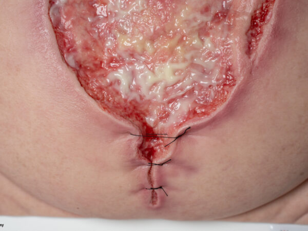 Frame Model 육아 조직이 있는 파열된 복부 - Image 3