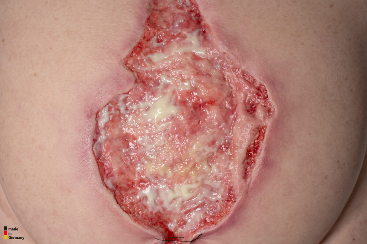 Frame Model 육아 조직이 있는 파열된 복부