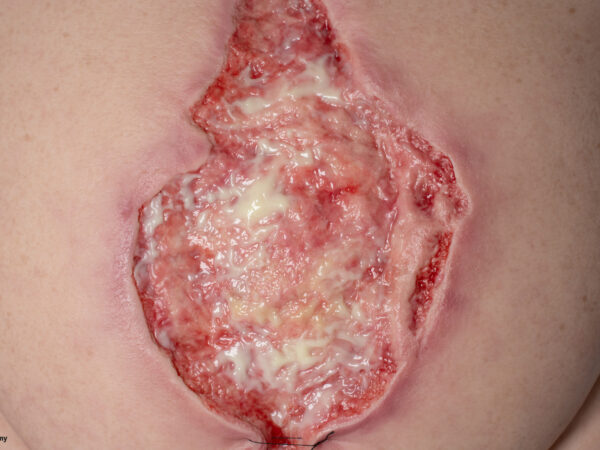 Frame Model 육아 조직이 있는 파열된 복부 - Image 4