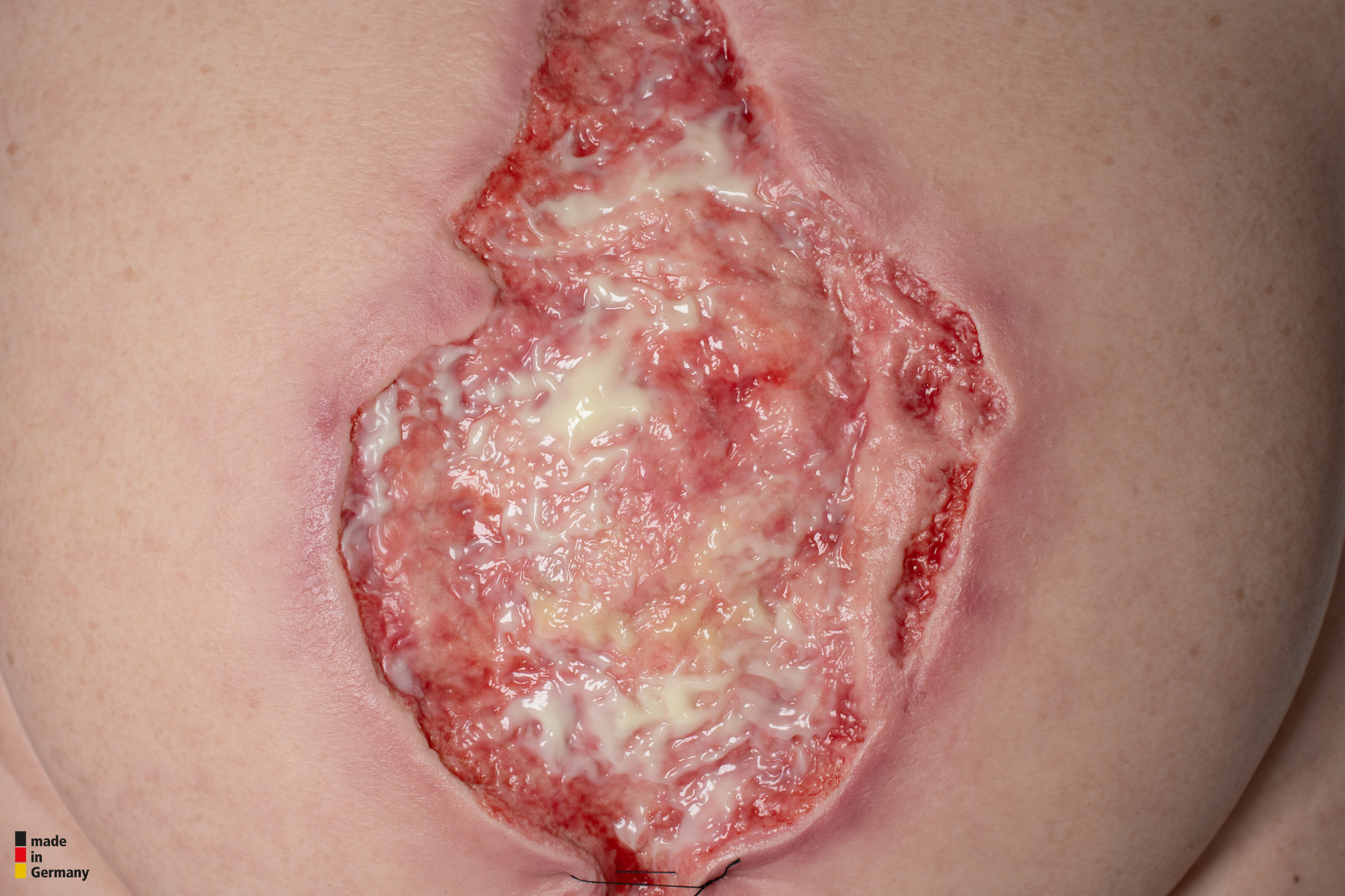 Frame Model 육아 조직이 있는 파열된 복부 - Image 4