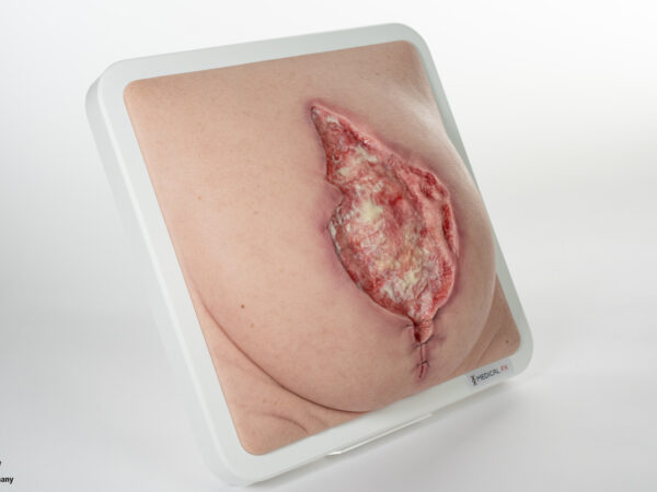 Frame Model 육아 조직이 있는 파열된 복부 - Image 5