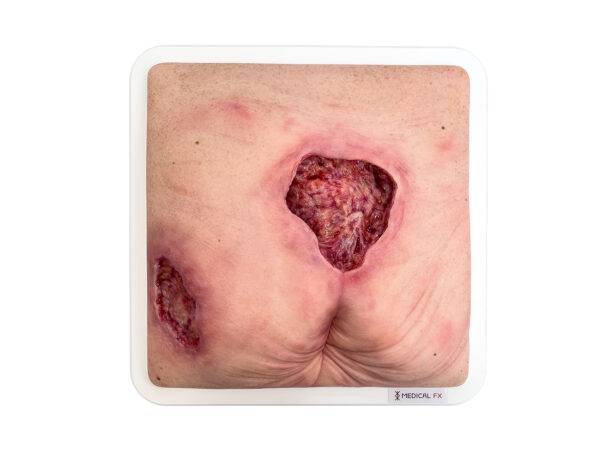 Das „Rahmenmodell Gesäß- und Hüftdekubitus“ von MEDICAL FX Germany ist eine präzise Nachbildung eines fortgeschrittenen Druckgeschwürs im Sakralbereich mit tiefer Wundtasche (Unte…