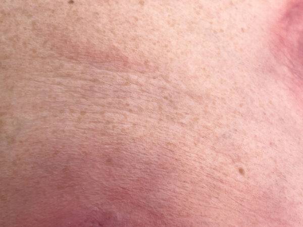 Das „Rahmenmodell Gesäß- und Hüftdekubitus“ von MEDICAL FX Germany ist eine präzise Nachbildung eines fortgeschrittenen Druckgeschwürs im Sakralbereich mit tiefer Wundtasche (Unte…