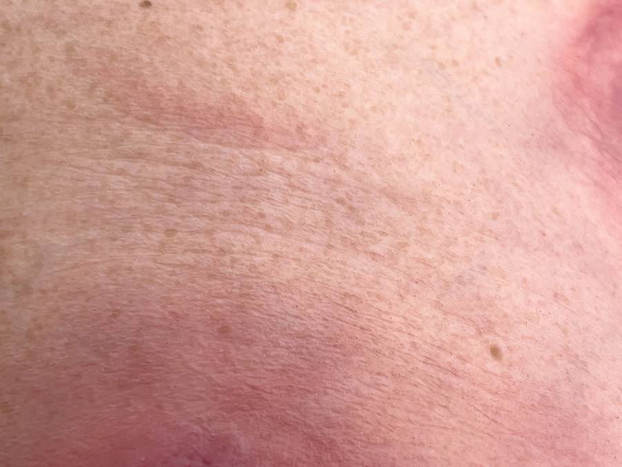 Das „Rahmenmodell Gesäß- und Hüftdekubitus“ von MEDICAL FX Germany ist eine präzise Nachbildung eines fortgeschrittenen Druckgeschwürs im Sakralbereich mit tiefer Wundtasche (Unte…