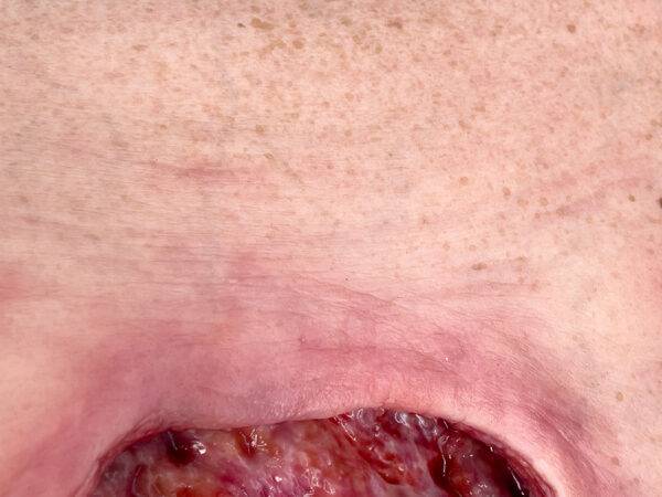 Das „Rahmenmodell Gesäß- und Hüftdekubitus“ von MEDICAL FX Germany ist eine präzise Nachbildung eines fortgeschrittenen Druckgeschwürs im Sakralbereich mit tiefer Wundtasche (Unte…