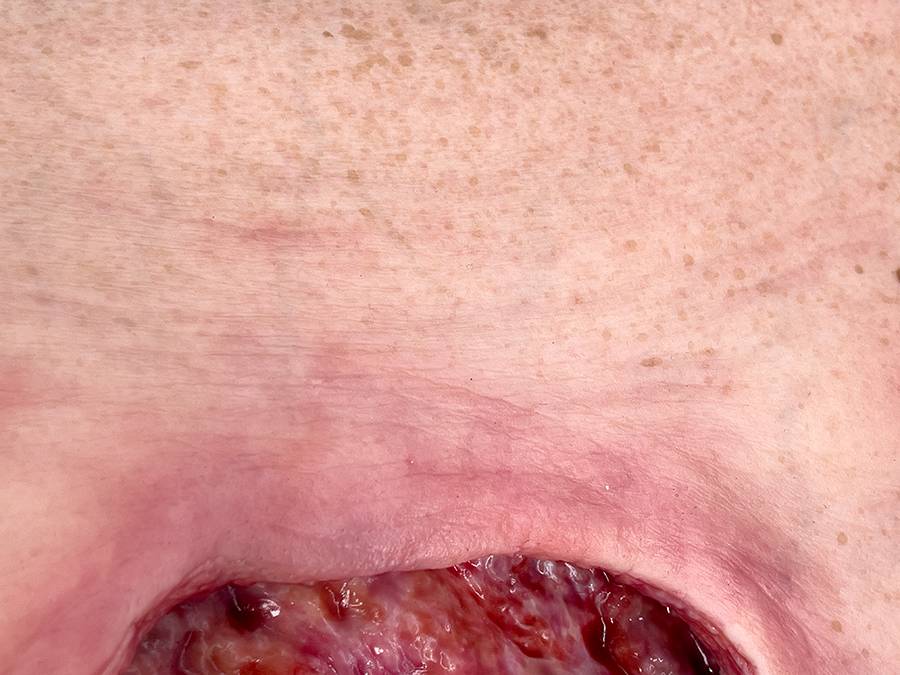 Das „Rahmenmodell Gesäß- und Hüftdekubitus“ von MEDICAL FX Germany ist eine präzise Nachbildung eines fortgeschrittenen Druckgeschwürs im Sakralbereich mit tiefer Wundtasche (Unte…