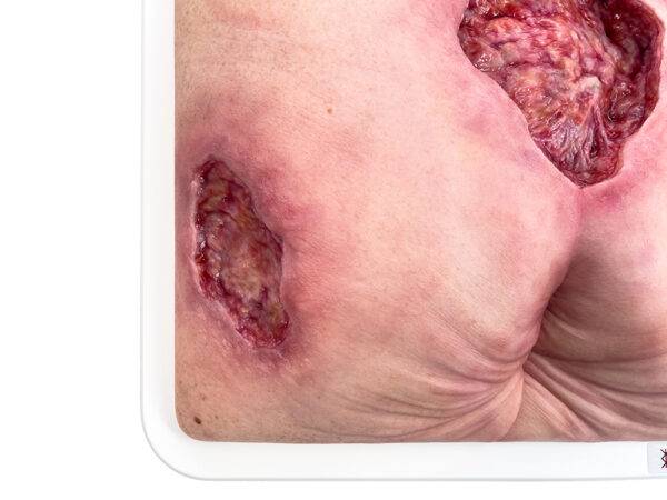 Das „Rahmenmodell Gesäß- und Hüftdekubitus“ von MEDICAL FX Germany ist eine präzise Nachbildung eines fortgeschrittenen Druckgeschwürs im Sakralbereich mit tiefer Wundtasche (Unte…