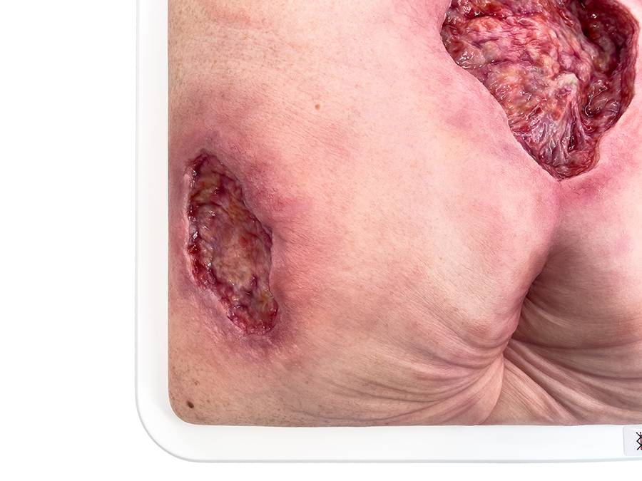Das „Rahmenmodell Gesäß- und Hüftdekubitus“ von MEDICAL FX Germany ist eine präzise Nachbildung eines fortgeschrittenen Druckgeschwürs im Sakralbereich mit tiefer Wundtasche (Unte…