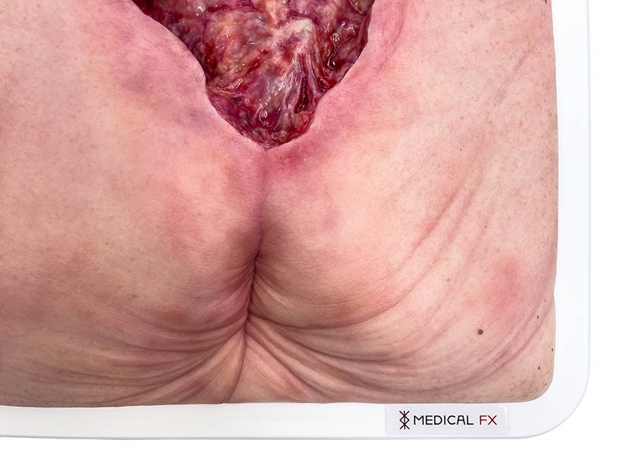 Das „Rahmenmodell Gesäß- und Hüftdekubitus“ von MEDICAL FX Germany ist eine präzise Nachbildung eines fortgeschrittenen Druckgeschwürs im Sakralbereich mit tiefer Wundtasche (Unte…