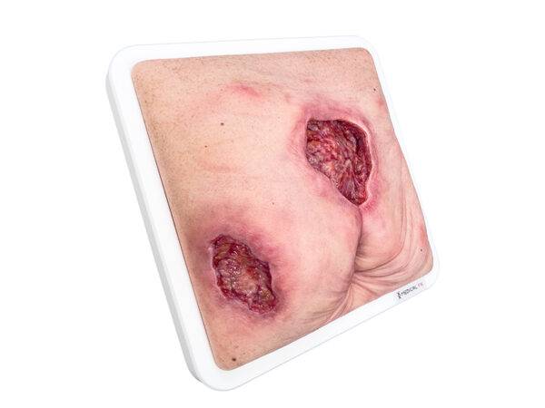 Das „Rahmenmodell Gesäß- und Hüftdekubitus“ von MEDICAL FX Germany ist eine präzise Nachbildung eines fortgeschrittenen Druckgeschwürs im Sakralbereich mit tiefer Wundtasche (Unte…