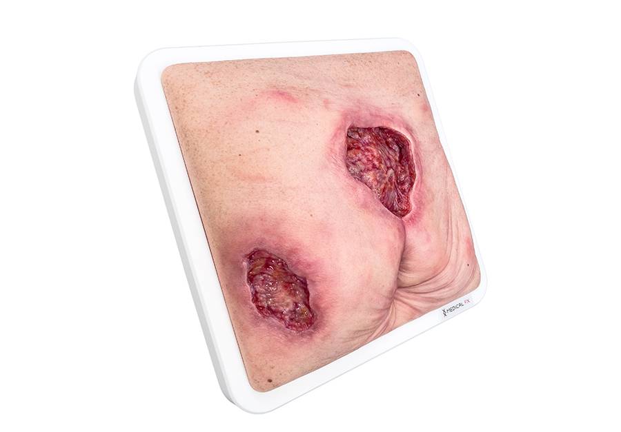 Das „Rahmenmodell Gesäß- und Hüftdekubitus“ von MEDICAL FX Germany ist eine präzise Nachbildung eines fortgeschrittenen Druckgeschwürs im Sakralbereich mit tiefer Wundtasche (Unte…