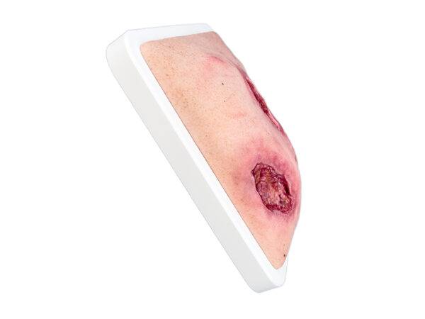 Das „Rahmenmodell Gesäß- und Hüftdekubitus“ von MEDICAL FX Germany ist eine präzise Nachbildung eines fortgeschrittenen Druckgeschwürs im Sakralbereich mit tiefer Wundtasche (Unte…