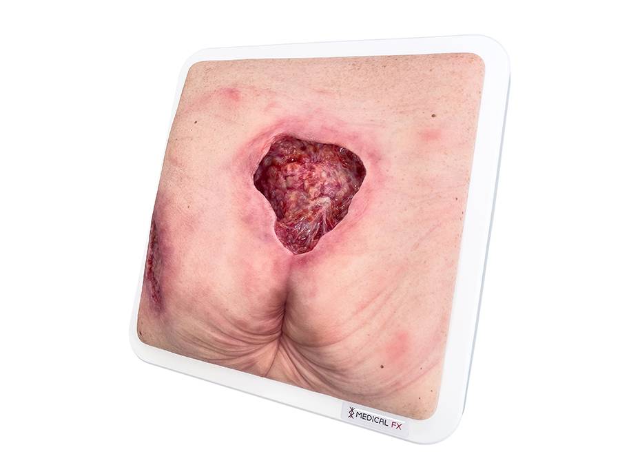 Das „Rahmenmodell Gesäß- und Hüftdekubitus“ von MEDICAL FX Germany ist eine präzise Nachbildung eines fortgeschrittenen Druckgeschwürs im Sakralbereich mit tiefer Wundtasche (Unte…