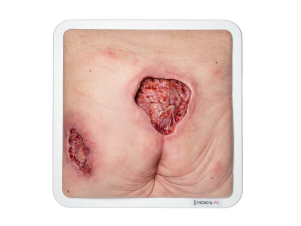 Frame Model Sacral and hip pressure ulcer