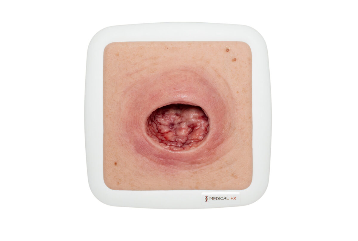 Frame Model Pressure Ulcer with Smooth Wound Edge