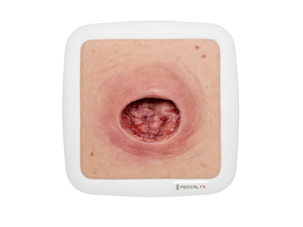 Frame Model Pressure Ulcer with Smooth Wound Edge