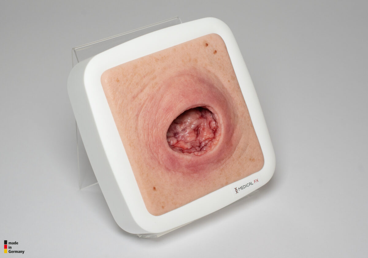 Frame Model Pressure Ulcer with Smooth Wound Edge