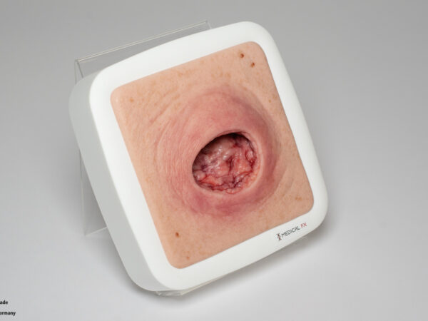 Frame Model Pressure Ulcer with Smooth Wound Edge - Image 4