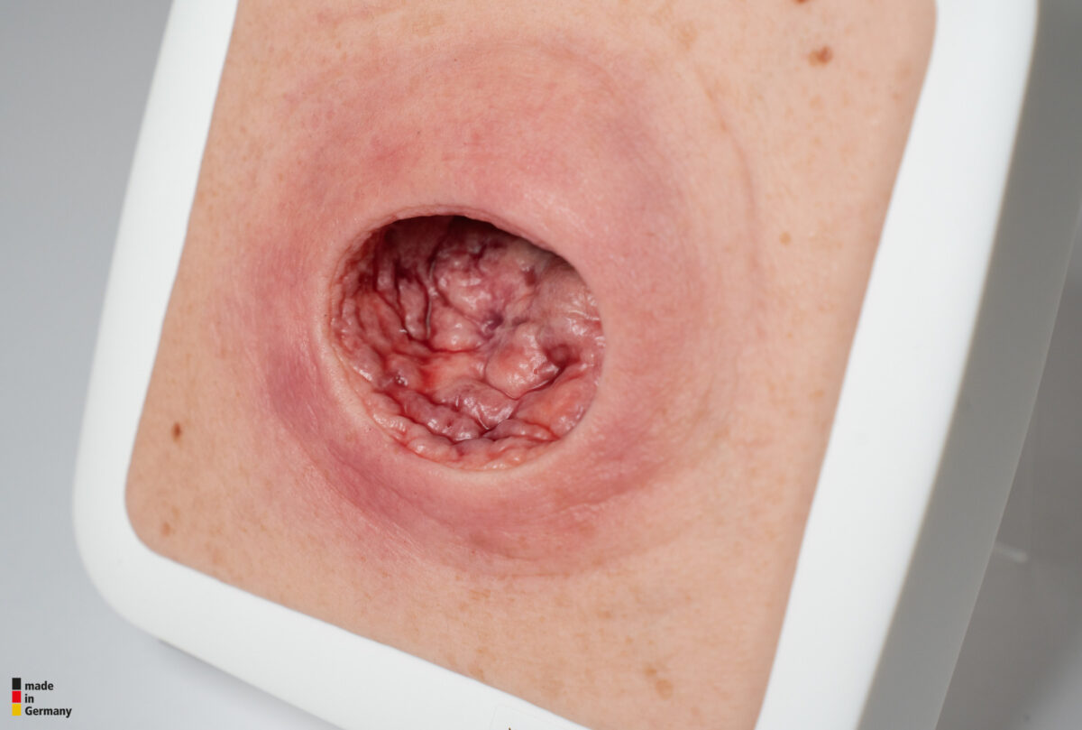 Frame Model Pressure Ulcer with Smooth Wound Edge