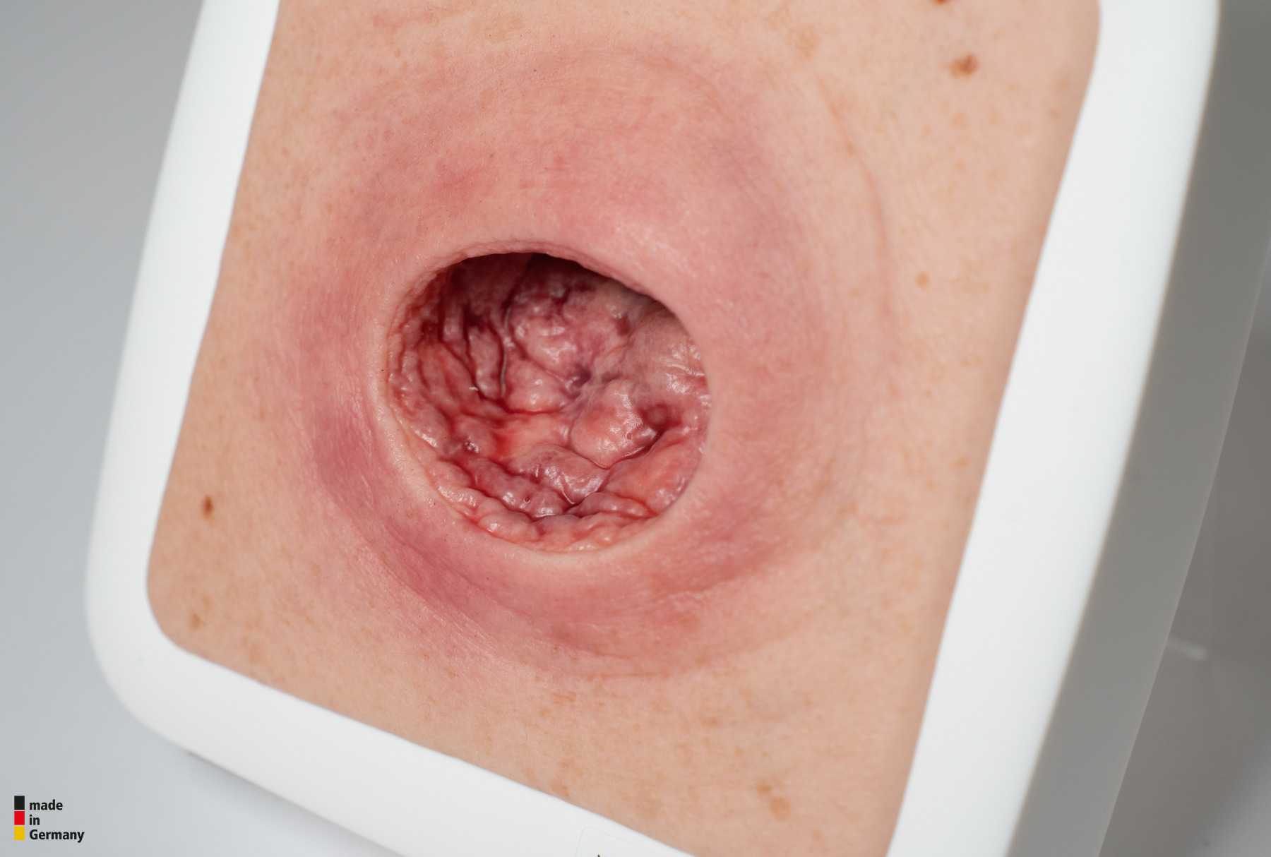 Frame Model Pressure Ulcer with Smooth Wound Edge - Image 6