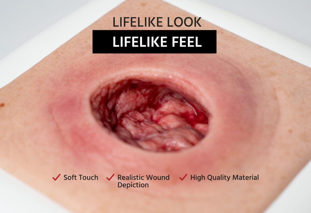 Frame Model Pressure Ulcer with Smooth Wound Edge