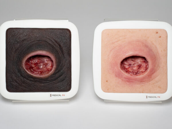 Frame Model Pressure Ulcer with Smooth Wound Edge - Image 3