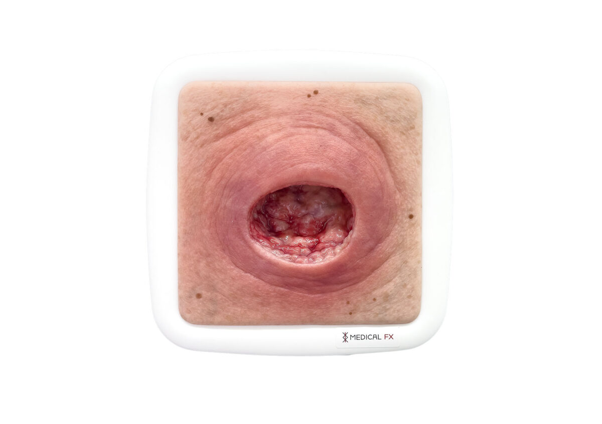 Rahmenmodell Dekubitus mit glattem Wundrand