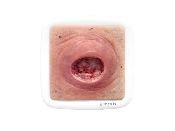 Frame Model Úlcera por Presión con Borde de Herida Liso - Image 7