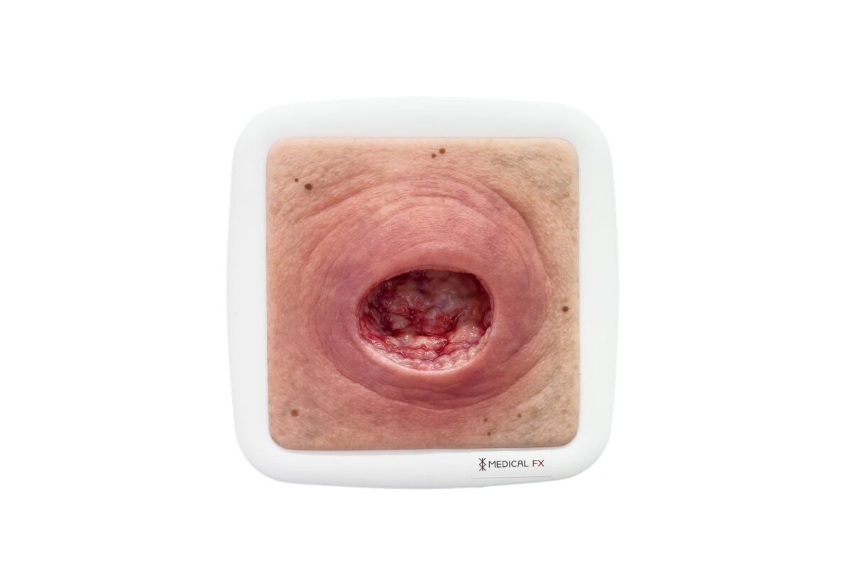 Rahmenmodell Dekubitus mit glattem Wundrand