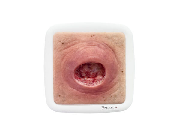 Rahmenmodell Dekubitus mit glattem Wundrand