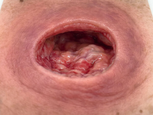 Frame Model Úlcera por Presión con Borde de Herida Liso - Image 4