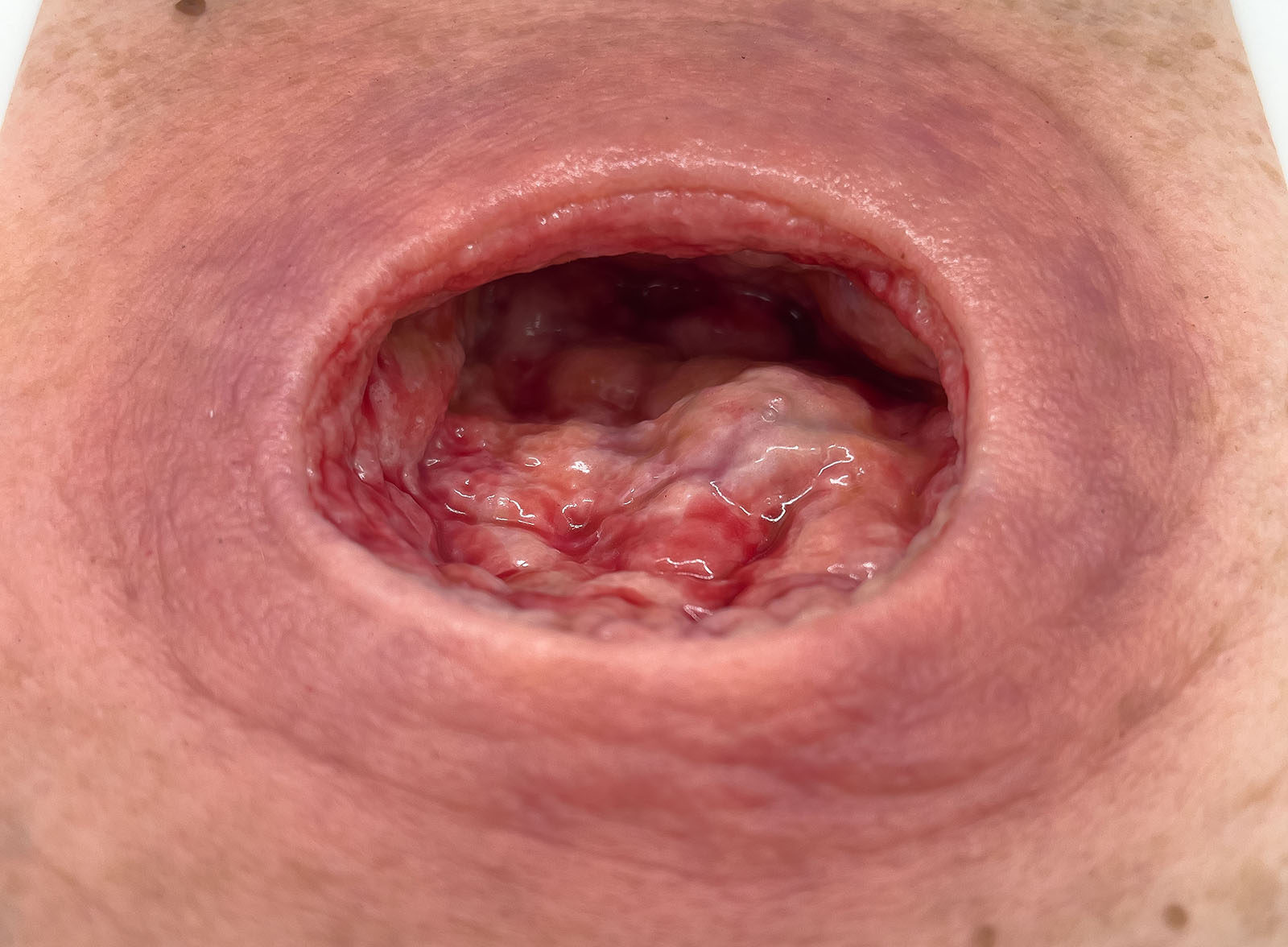 Frame Model Úlcera por Presión con Borde de Herida Liso - Image 4