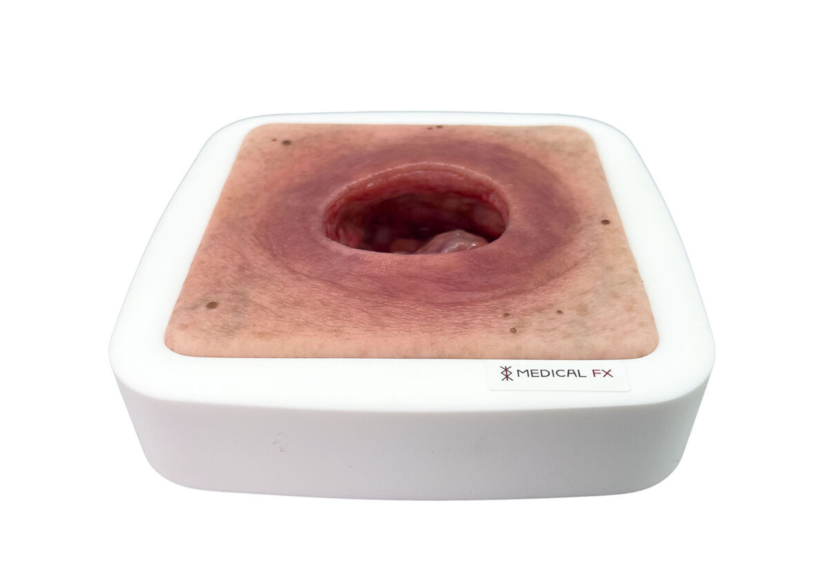 Rahmenmodell Dekubitus mit glattem Wundrand