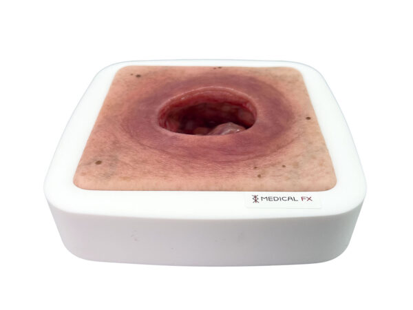 Frame Model Úlcera por Presión con Borde de Herida Liso - Image 2