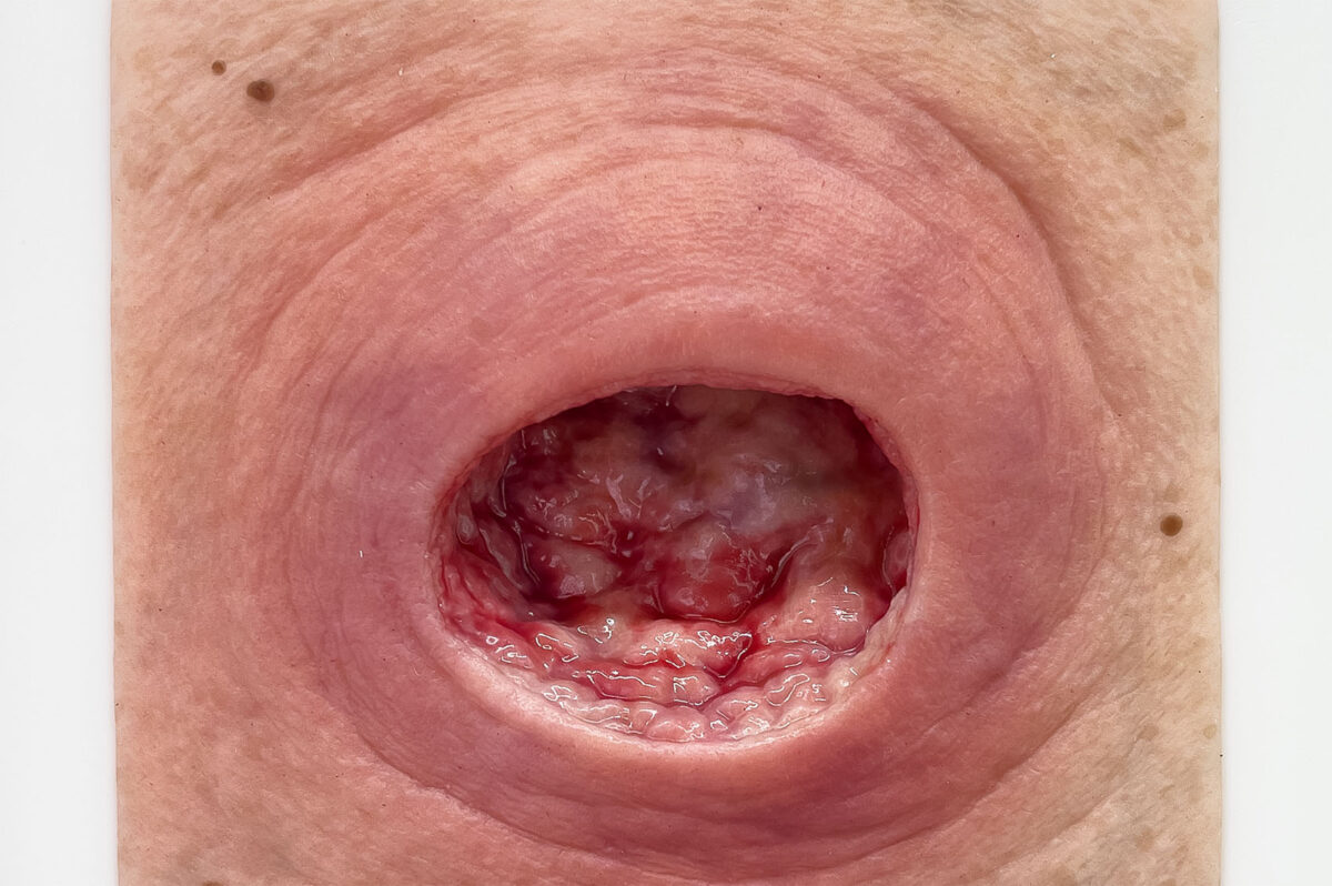 Rahmenmodell Dekubitus mit glattem Wundrand