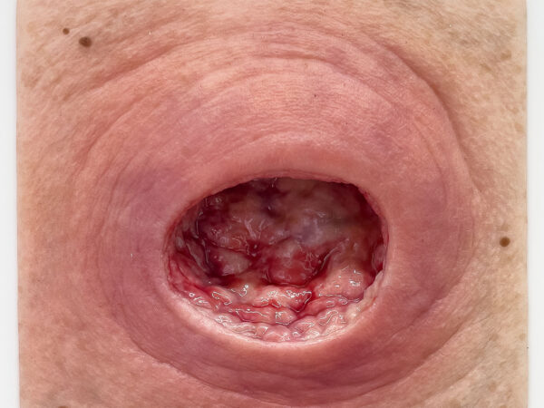 Frame Model Úlcera por Presión con Borde de Herida Liso - Image 3