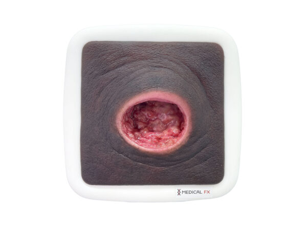 Frame Model Úlcera por Presión con Borde de Herida Liso - Image 8