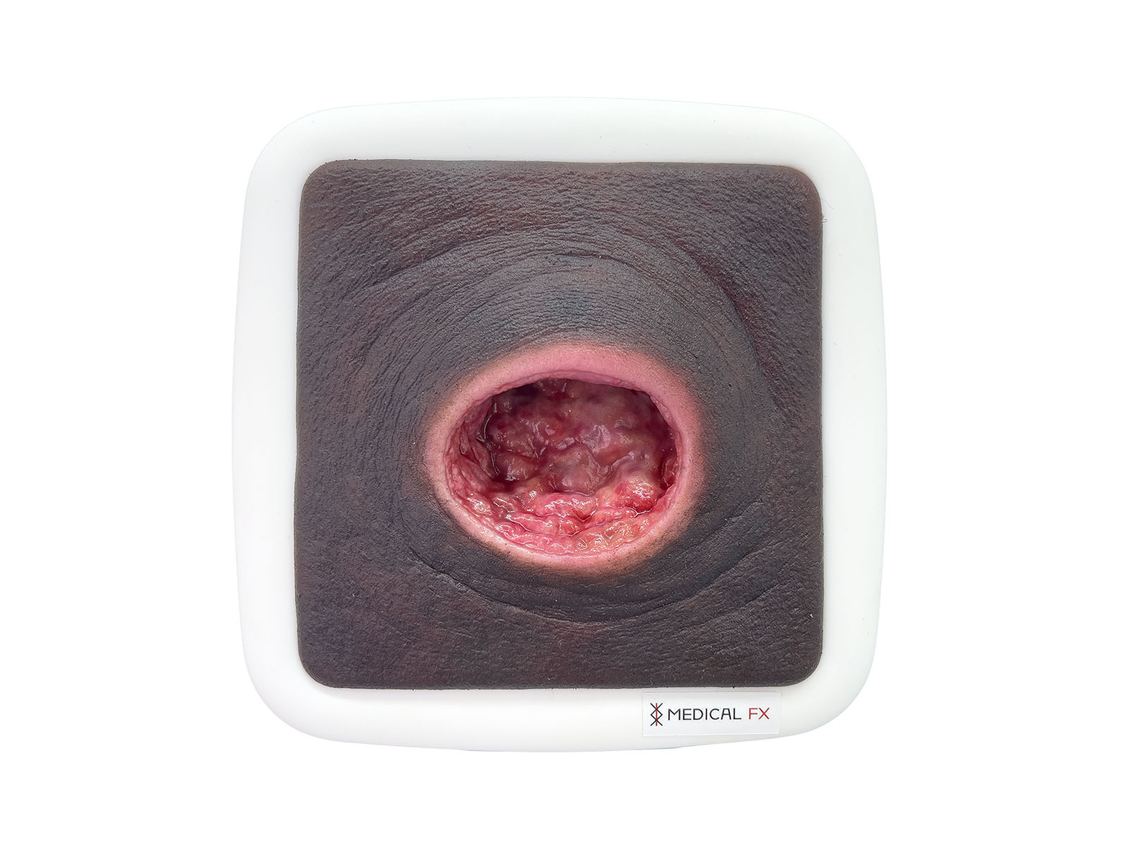 Frame Model Úlcera por Presión con Borde de Herida Liso - Image 8