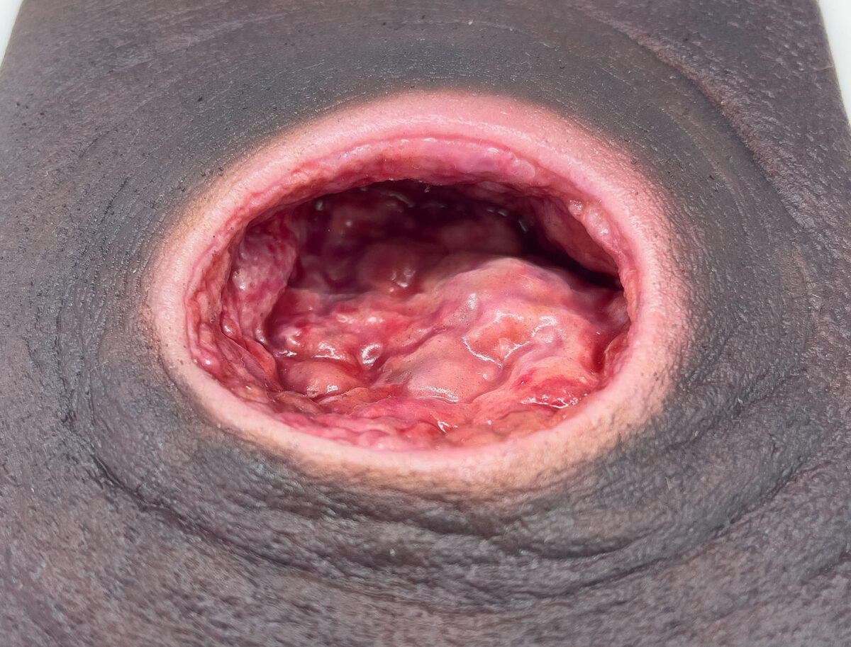 Rahmenmodell Dekubitus mit glattem Wundrand