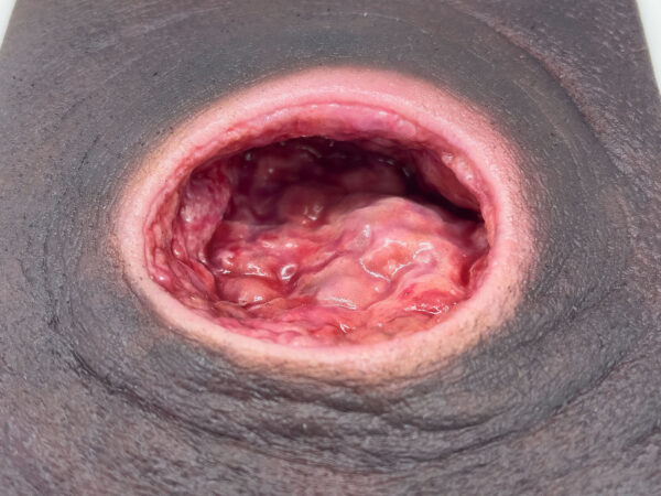 Frame Model Úlcera por Presión con Borde de Herida Liso - Image 6