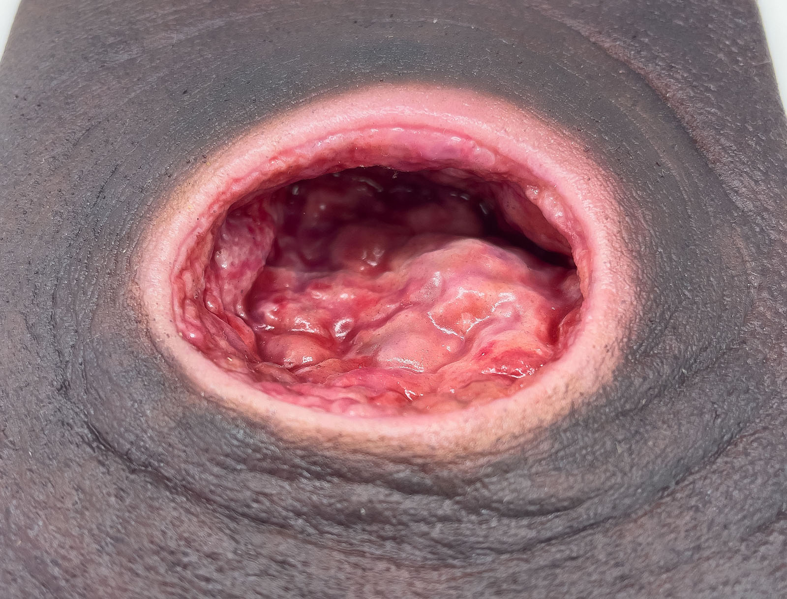 Frame Model Úlcera por Presión con Borde de Herida Liso - Image 6