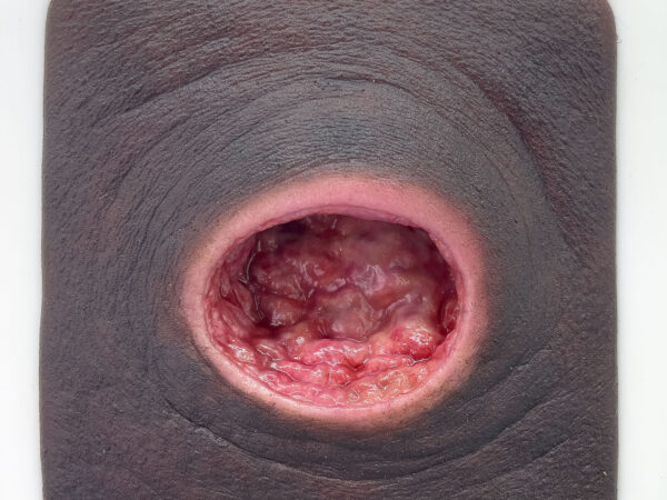 Frame Model Úlcera por Presión con Borde de Herida Liso - Image 5