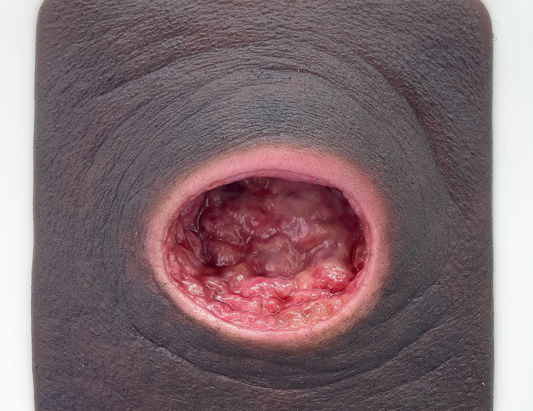 Frame Model Úlcera por Presión con Borde de Herida Liso - Image 5