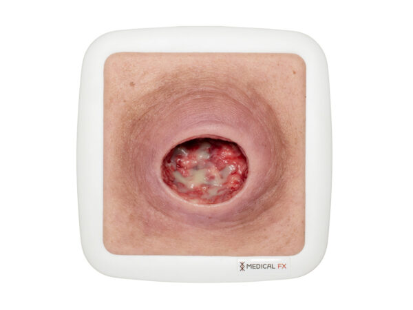 Frame Model Pressure Ulcer with Smooth Wound Edge - Image 7
