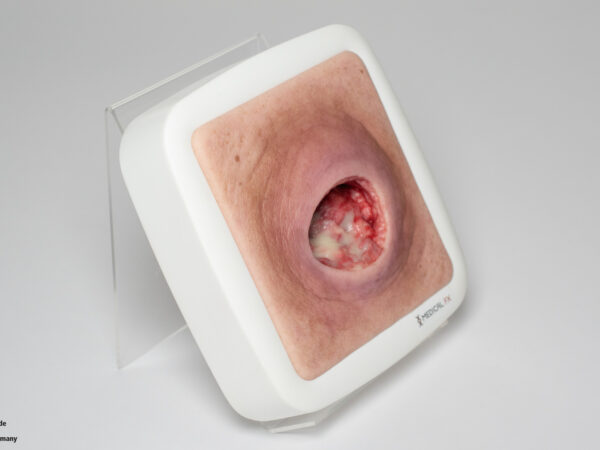 Frame Model Pressure Ulcer with Smooth Wound Edge - Image 9