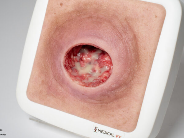 Frame Model Pressure Ulcer with Smooth Wound Edge - Image 10