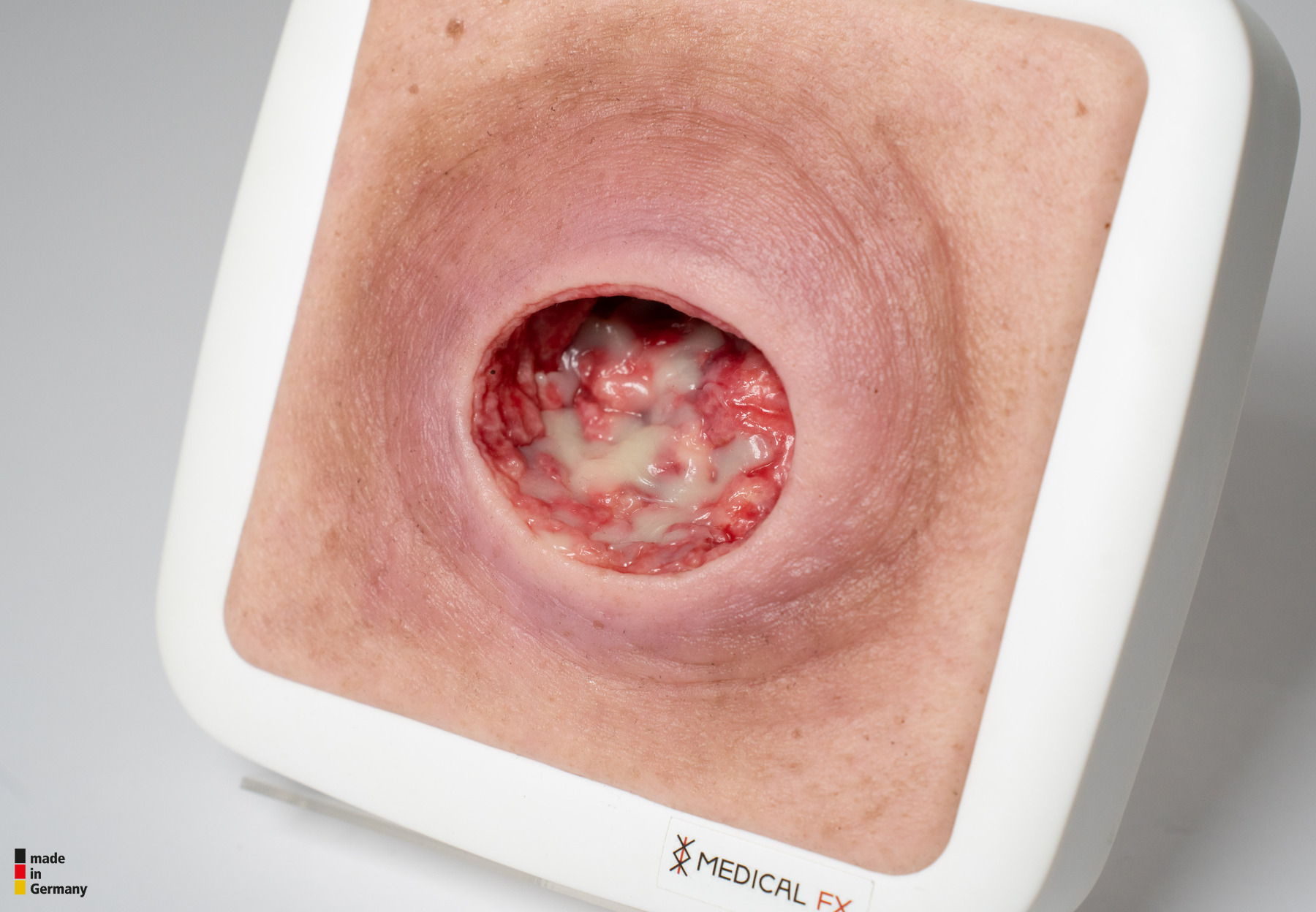 Frame Model Pressure Ulcer with Smooth Wound Edge - Image 10