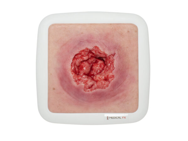 Frame Model Pressure ulcer with frayed wound edge